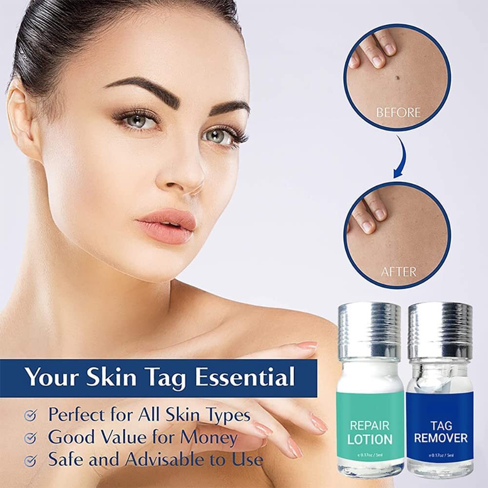 Asmoxa Skin Tag Mole & Wart Remover - Image 3
